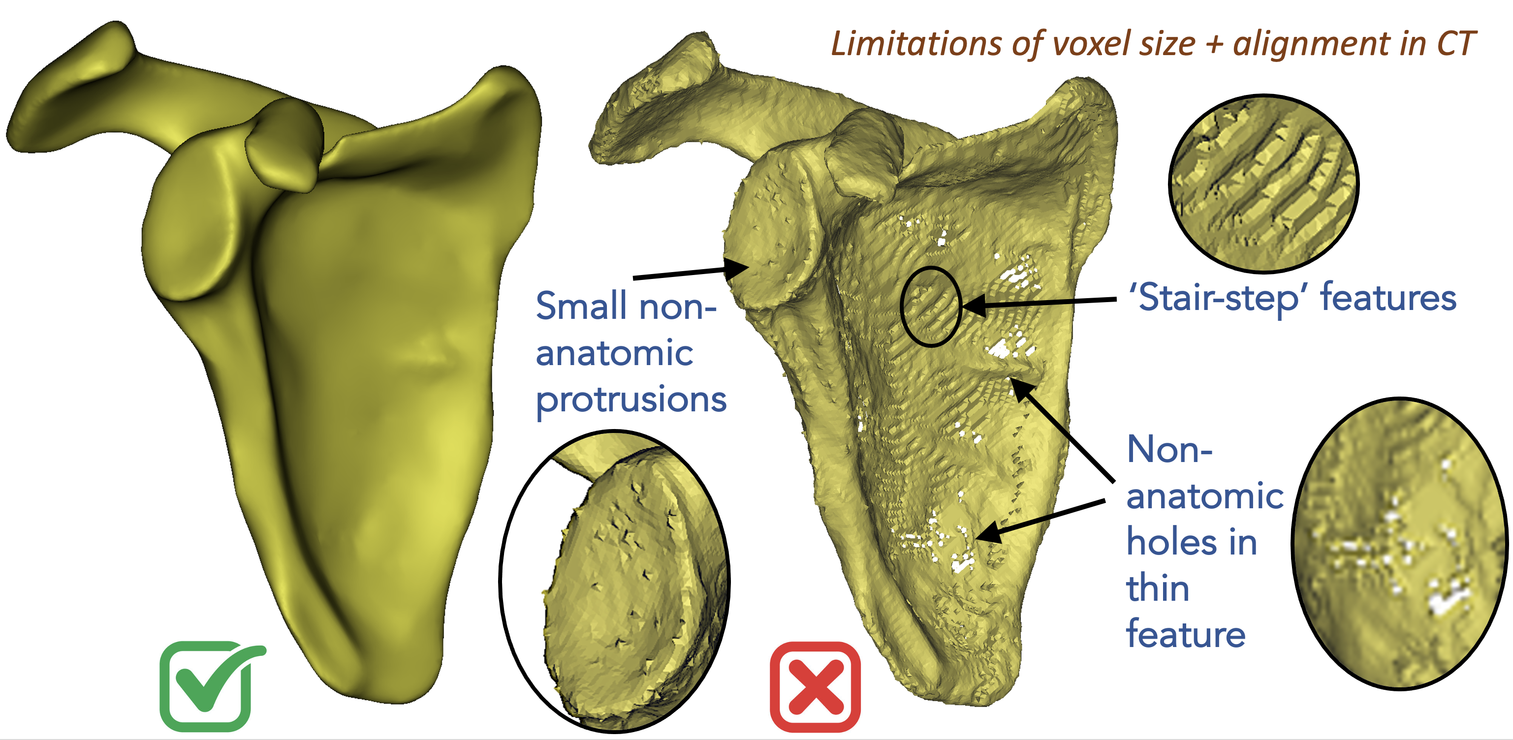 Scapula - good and bad surfaces